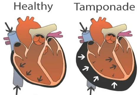 Cardiac tamponade is a clinical syndrome caused by the accumulation of fluid in the pericardial ...