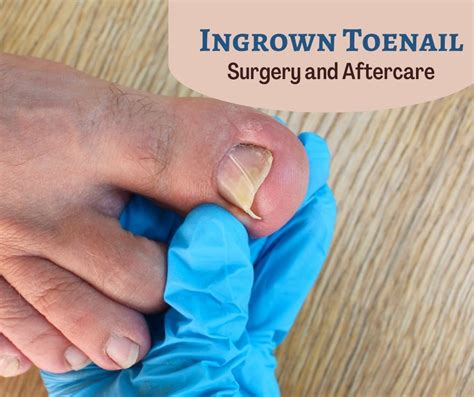 Ingrown Toenail Removal Aftercare