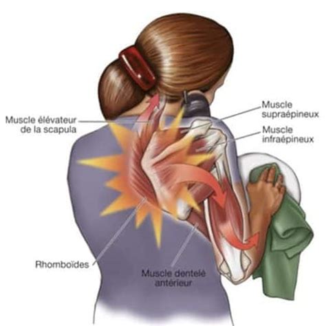 Syndrome scapulo-costal - Pathologies des nerfs périphériques