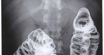 Barium Enema - Double Contrast - Large Bowel Examination and Preparation - RadTechOnDuty