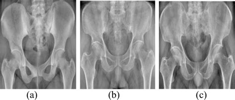 Pelvic X-ray image (a). Normal bone mass; (b). Lower bone mass; (c ...