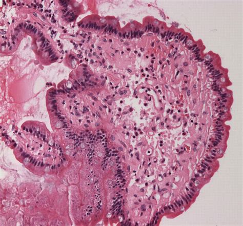 File:Small bowel duodenum with amyloid deposition 20X.jpg - Wikipedia, the free encyclopedia