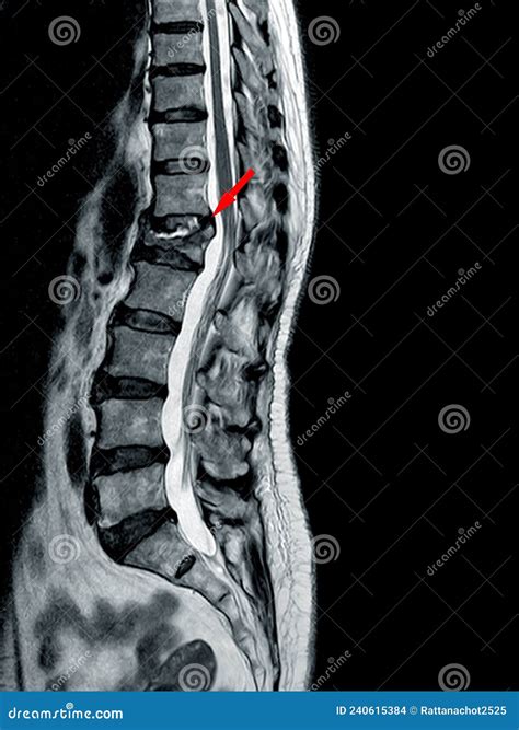 MRI of THORACOLUMBAR SPINE Moderate To Severe Compression Fracture of L1 Vertebra Stock Photo ...