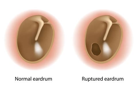 Tympanoplasty and Mastoidectomy (Tympanomastoidectomy)