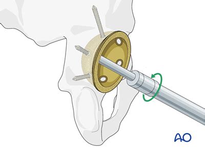 Total hip arthroplasty for Displaced subcapital femoral neck fractures