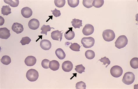 Acanthocytes – Cells and Smears