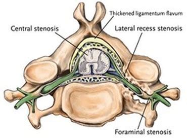 Neurogenic Claudication - Joint Pain