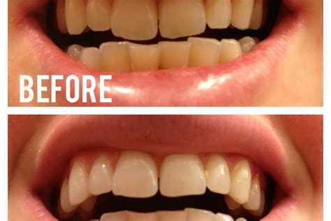 Does Activated Charcoal Teeth Whitening Works? You Need to Know This