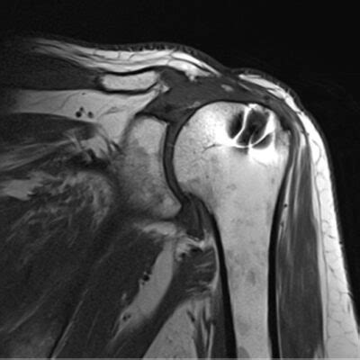 Metal \Titanium Artifact MRI | Magnetic Susceptibility Artifact MRI