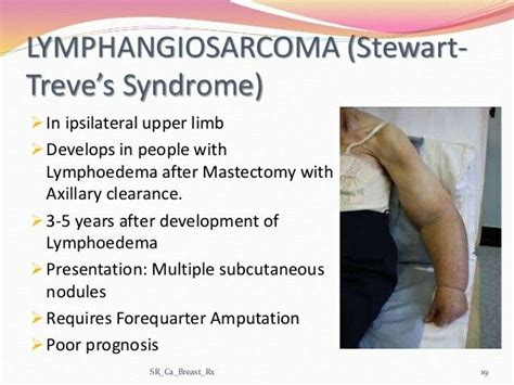 Lymphangiosarcoma = Stewart Treve syndrome ... 【 Note: After Mastectomy 】 | Lymphoedema ...