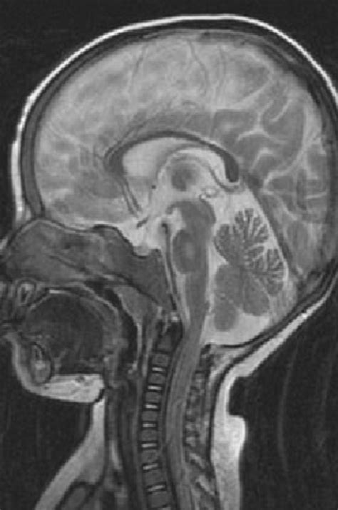 Brain MRI showing altered signal intensity in the central pons due to ...