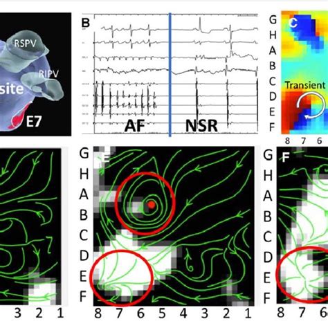 Persistent atrial fibrillation (AF) in a 67-y-old woman sustained by a... | Download Scientific ...