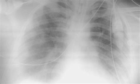 Chest x-ray has lower sensitivity for detecting thoracic injury in ...