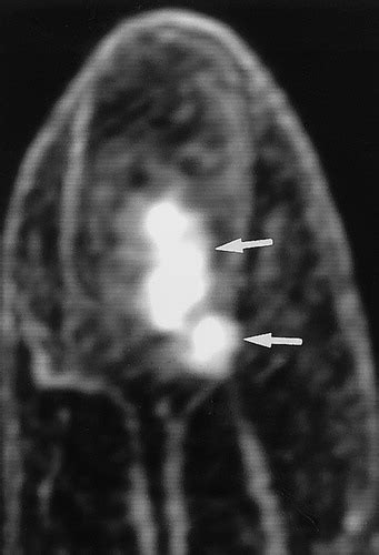 Glomus Tumor Mri