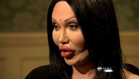 Botched Plastic Surgeries: Pete Burns Sued Following Botched Lip Surgery - dBTechno