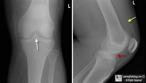 Learning Radiology - avulsion, fracture, anterior, tibial, spine