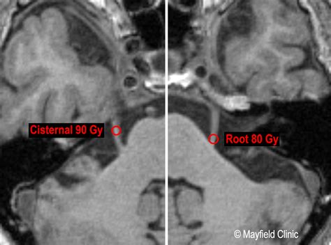 Q&A: Gamma Knife radiosurgery as a treatment for trigeminal neuralgia with Ronald E. Warnick, MD