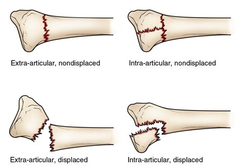 Distal Radius Fractures (Broken Wrist) - OrthoInfo - AAOS