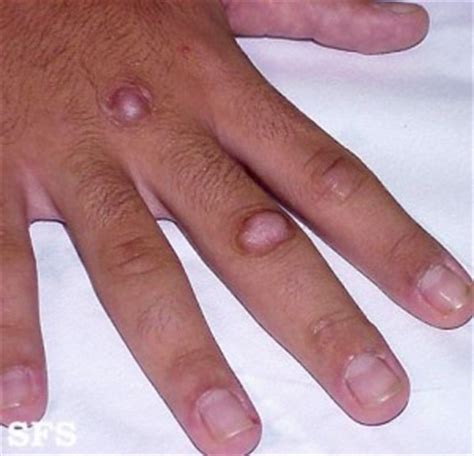 Knuckle Pads – Causes, Symptoms, Pictures and Treatment | Healthhype.com