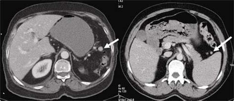 Contrasted axial CT: a. Accessory spleen is monitored, b. Accessory ...