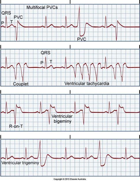 130 Cardiac rhythms ideas in 2021 | cardiac rhythms, cardiac, ecg ...