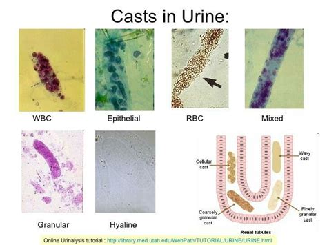 Urine casts | Medical technology, Medical laboratory, Medical laboratory science