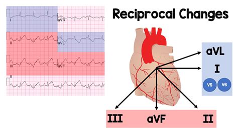 Ecg Localization Of Stemi - LOCAAKJ