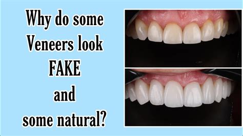 Fake vs. Natural looking Dental Veneers - YouTube