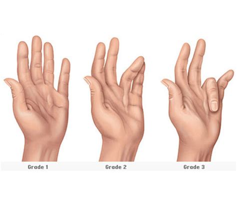 Dupuytren's contracture - South Florida Hand Surgery