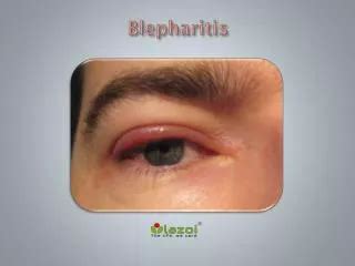 PPT - Blepharitis Treatment Doctor Drlunaxu.com PowerPoint Presentation ...