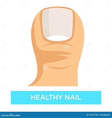 Healthy Nail Toenail Fungus Infection Prevention Medicine and ...