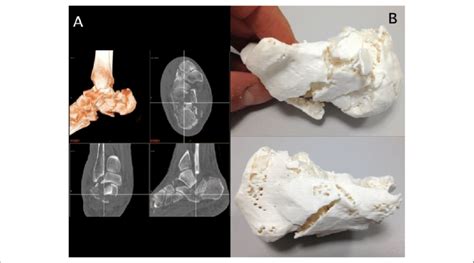 Calcaneal fracture of a 65-year-old woman: CT scan MPR and volume... | Download Scientific Diagram