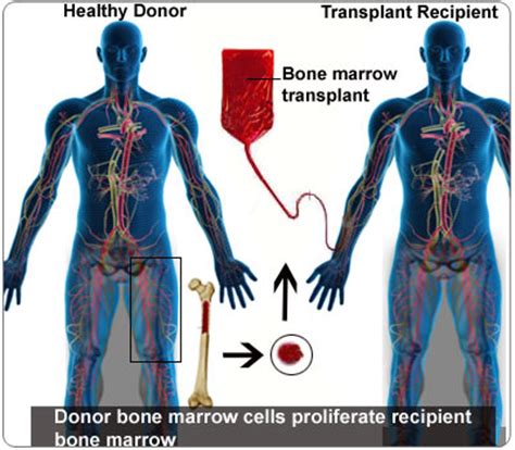 Bone Marrow Transplantation - Types - Procedure - Indications - Complications