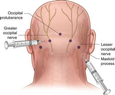 occipital neuralgia - Google Search | Leather backpack, Leather ...