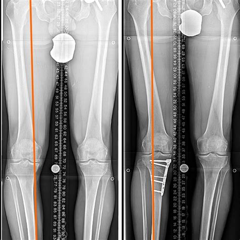 High tibial osteotomy with plate and screws. A: Pre-operation; B ...