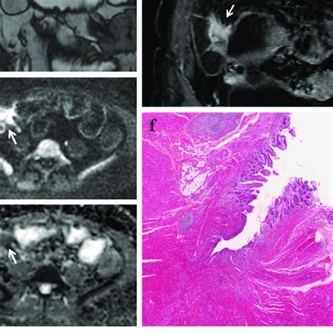 Qualitative and quantitative MR enterography findings of bowel ...