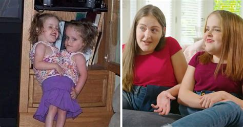 13 Years After Conjoined Twins 'Cut In Half' They Share Glimpse Inside Their Teenage Life