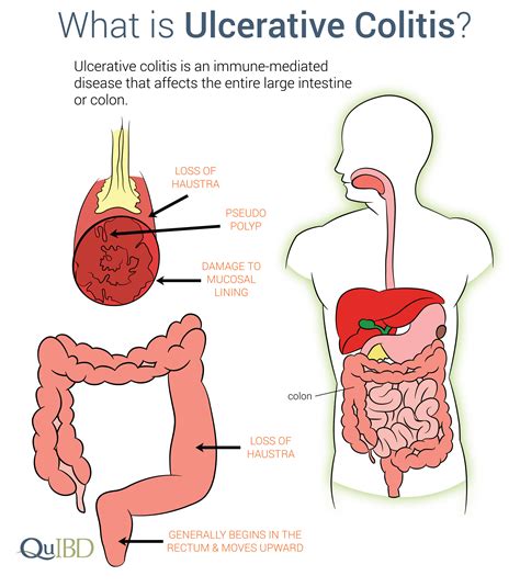 Ulcerative Colitis Symptoms IBD Prevalence Impact Causes