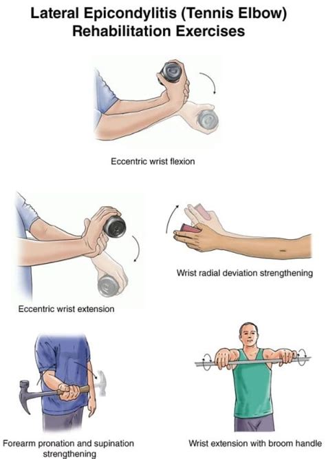 Seriously! 42+ Reasons for Tennis Elbow Treatment: The tennis elbow is also called lateral ...