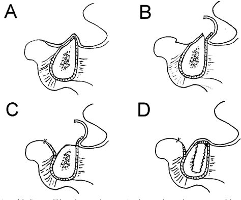 Figure 3 from Transpositioned flap vestibuloplasty combined with implant surgery in the severely ...