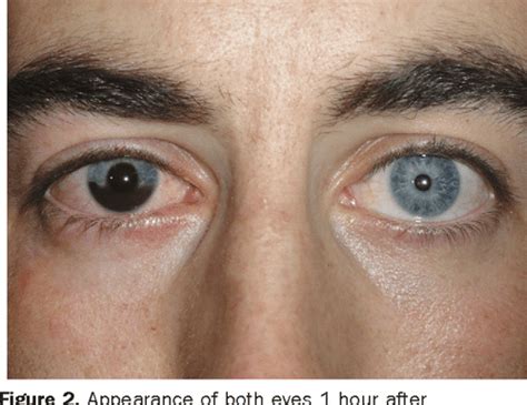 Figure 2 from Eye pain after blunt ocular trauma. Traumatic mydriasis ...