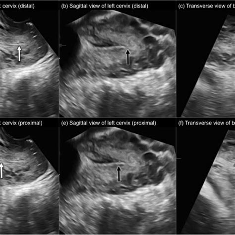 Intraoperative photos of uterus didelphys during cesarean section: (a)... | Download Scientific ...