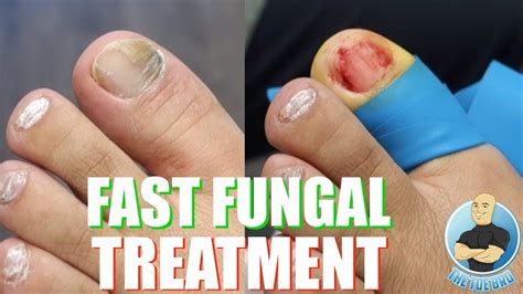 best products for toenail fungus - Toenail Fungus Treatment | Toenail Fungus Treatment