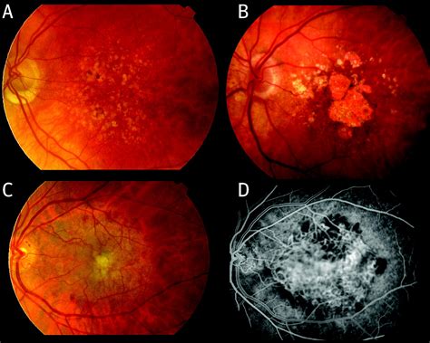 Age related macular degeneration | The BMJ