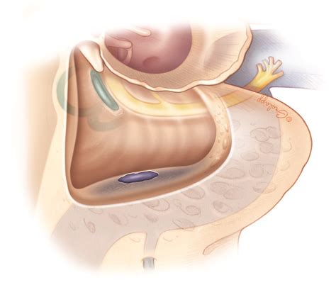 Complications of Mastoidectomy – Oto Surgery Atlas