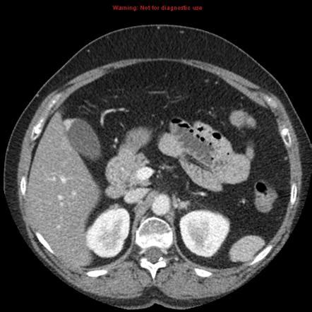 Adenomyomatosis of the gallbladder | Radiology Reference Article ...