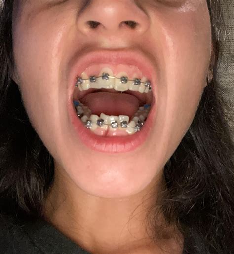 Brace Free! : r/braces