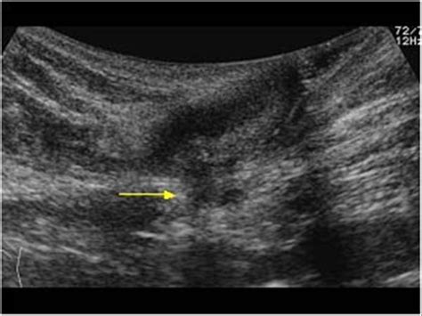 Omphalomesenteric Duct Remnants