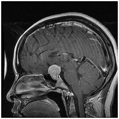 Pituitary adenoma with gangliocytoma: Report of two cases