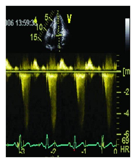 Echocardiographic aspect of HOCM before/after a myectomy ((a)–(d)) and ...